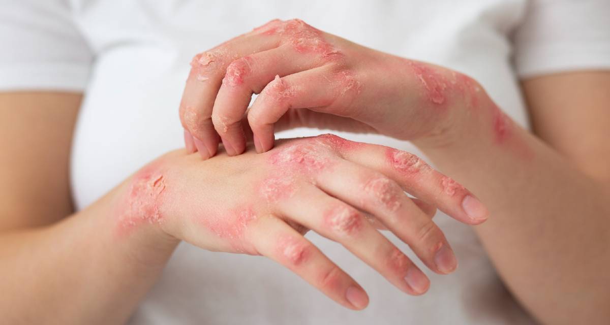 Escleroderma