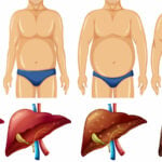 Sintomas de gordura no fígado