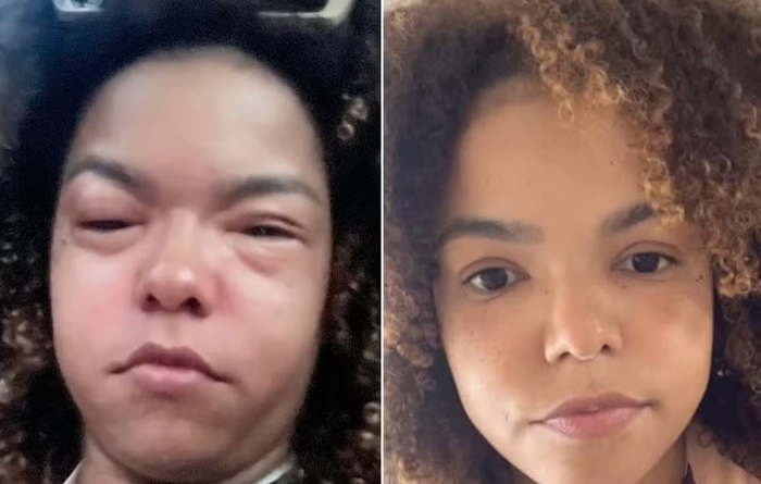 Reação alérgica de Jeniffer Nascimento