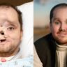 Homem surpreende ao realizar transplante de rosto inovador: "Segunda chance"