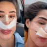 Ex-"BBB" Deniziane detalha recuperação de rinoplastia: "Muito difícil para dormir"