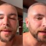 Ex-"BBB" Gustavo Marsengo mostra inchaço no rosto após transplante capilar: "Normal acontecer"
