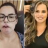 Influencer que perdeu o lábio por uso de PMMA mostra rosto após cirurgias de reconstrução