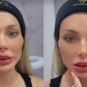 Andressa Urach surpreende com novo preenchimento labial: 'Estou amando'