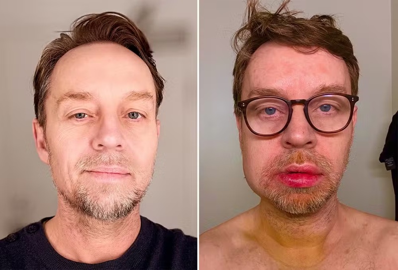 Cantor Darren Hayes quebra mandíbula e dentes após séries de desmaios; entenda o que houve