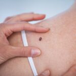 Homens e mulheres têm câncer de pele em diferentes partes do corpo; veja quais