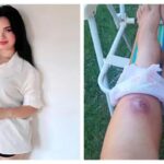 Influencer tira pelo encravado com pinça e tem grave infecção: 'Quase parei de andar'