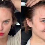 Filha de Bruce Willis e Demi Moore mostra consequências de transtorno que a faz arrancar a própria pele; conheça Filha de Bruce Willis e Demi Moore mostra consequências de transtorno que a faz arrancar a própria pele; conheça