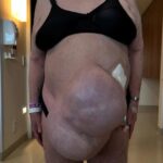 Mulher surpreende ao ficar com hérnia gigante por 13 anos: “Não queriam operar” Mulher surpreende ao ficar com hérnia gigante por 13 anos: “Não queriam operar”