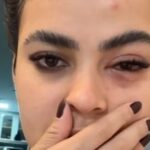 Influencer viraliza após desenvolver infecção no olho causada por mosca de banheiro; entenda Influencer viraliza após desenvolver infecção no olho causada por mosca de banheiro; entenda