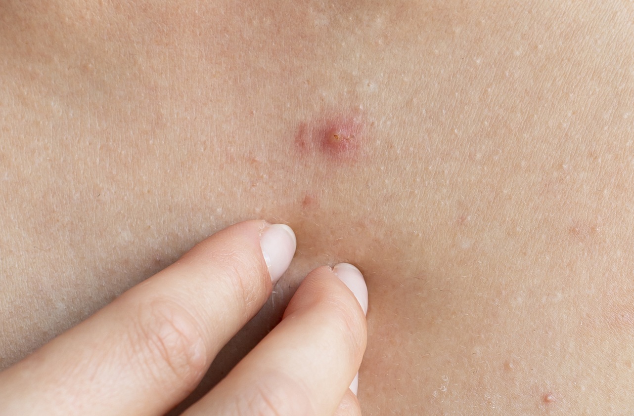 Mulher confunde câncer de pele com espinha: "Até espremi"