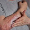 Estresse pode ativar e agravar crises de dermatite atópica, diz estudo